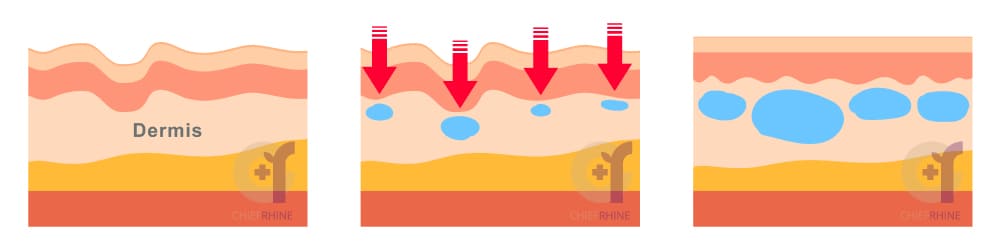 玻尿酸的作用示意圖，保濕鎖水讓肌膚恢復彈性光澤